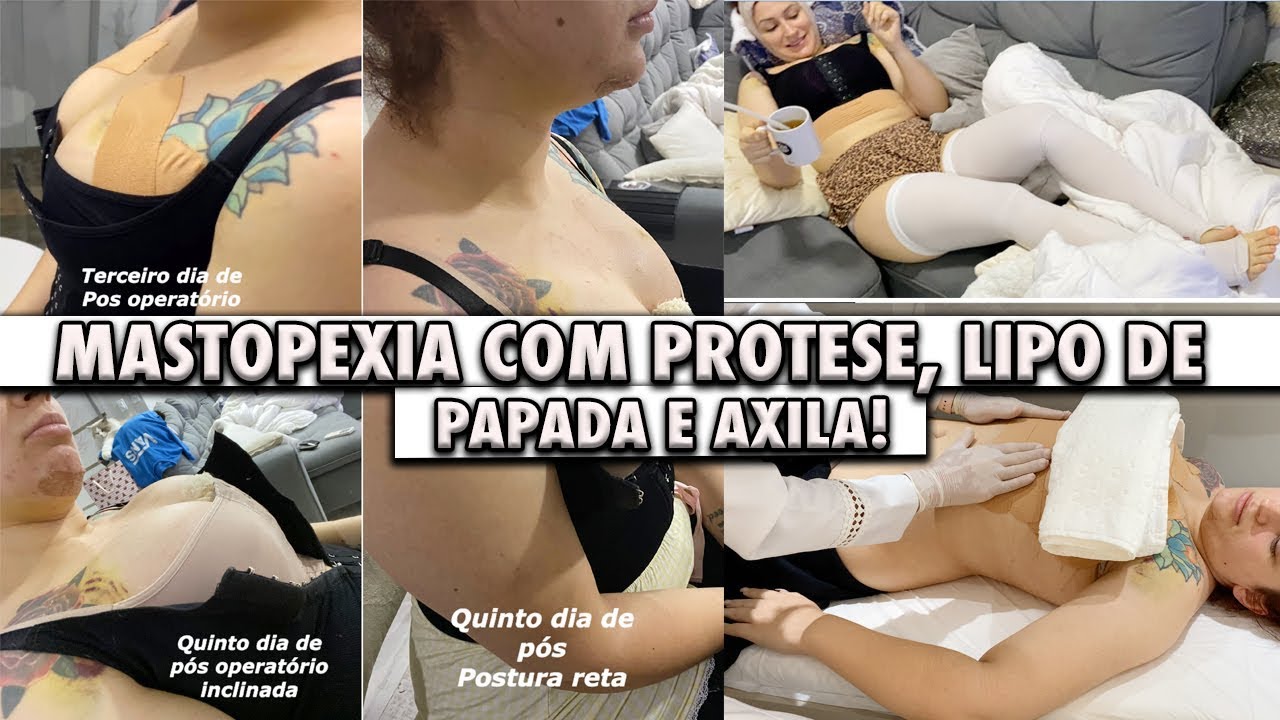 Pós Operatório: MASTOPEXIA COM PROTÉSE E LIPO DE PAPADA E AXILA - 1 Semana! | Duda Fernandes