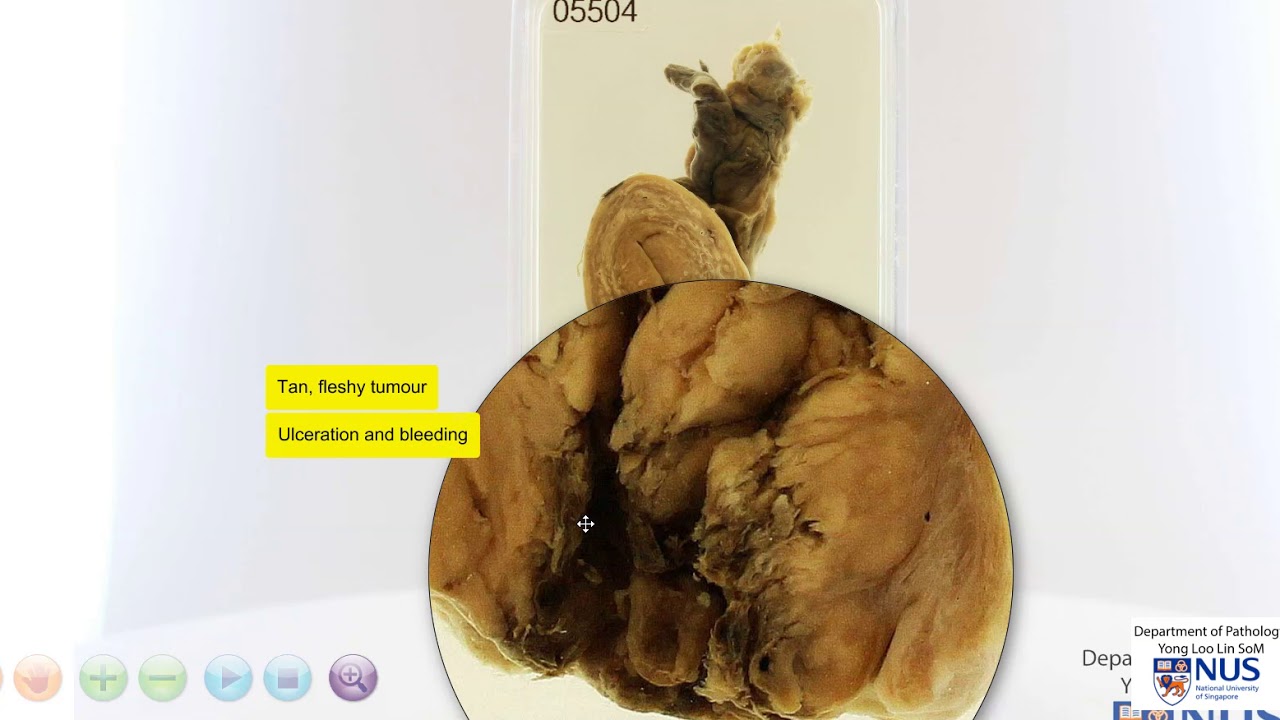 Uterus and cervix - Cervical carcinoma