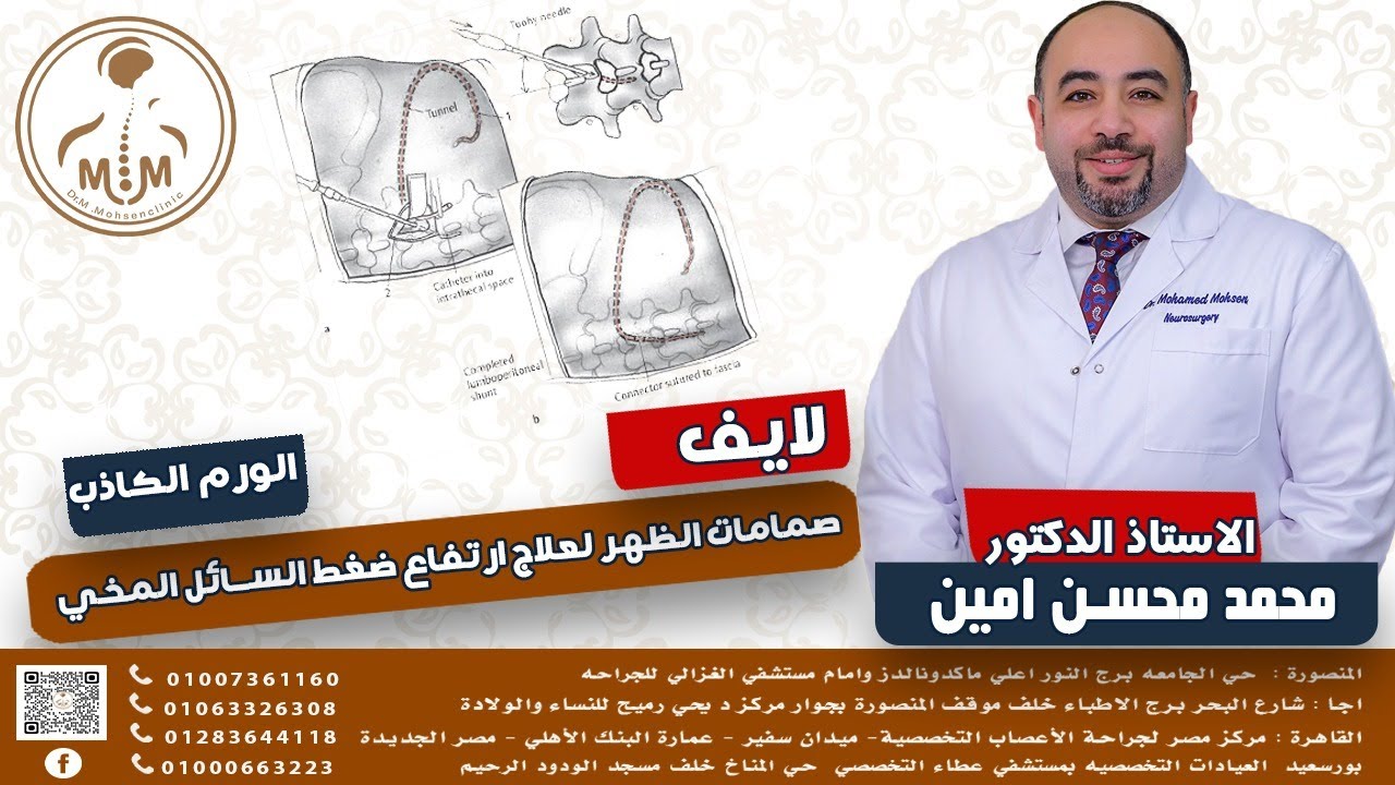 صمامات الظهر لعلاج ارتفاع السائل المخي