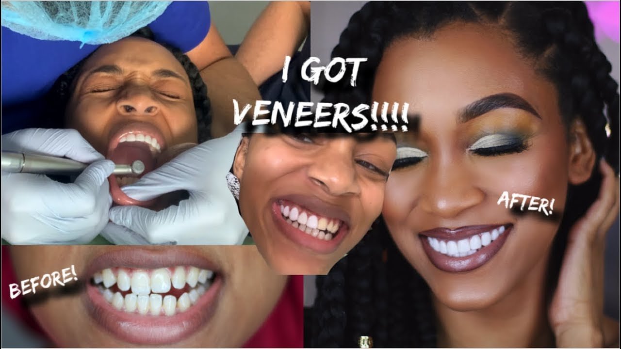 I WENT TO DR & GOT VENEERS!! |VLOG|