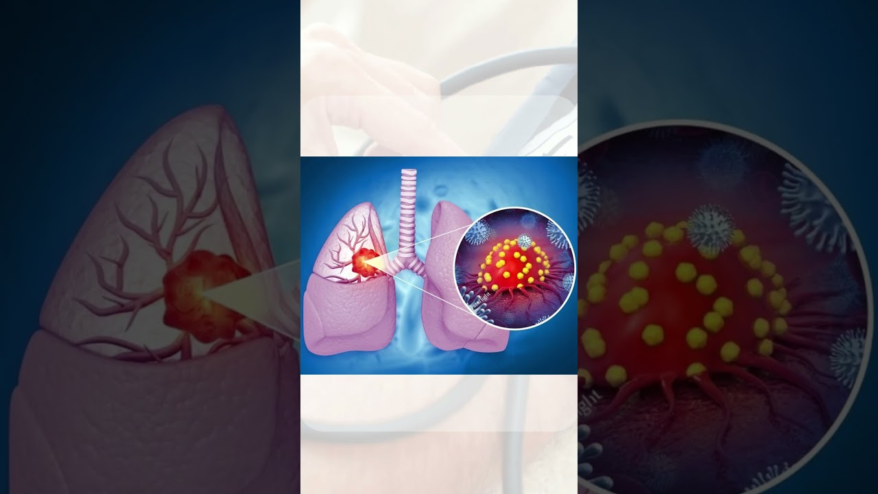 Dyspnea