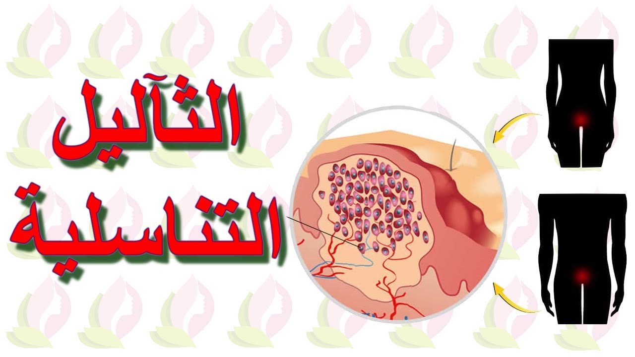 الثآليل التناسلية Genital warts - الأسباب و العلاج