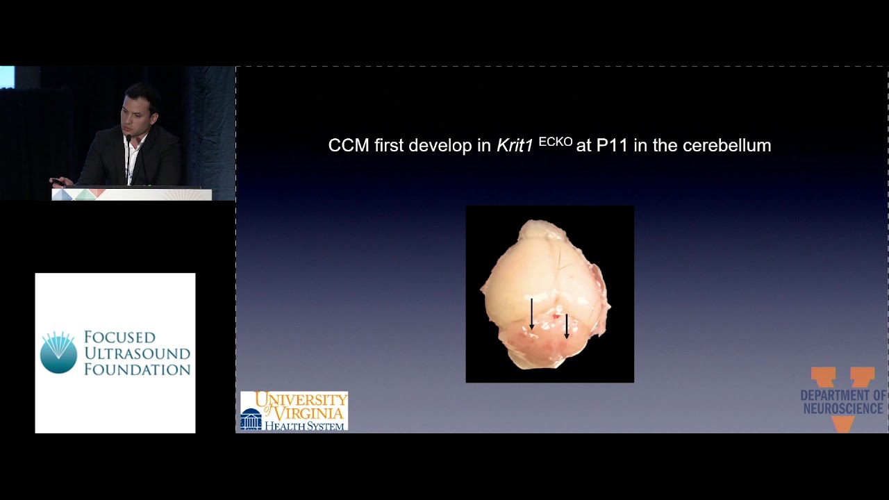 Pedro Norat - FUS treatment of cerebral cavernous malformations (2018)