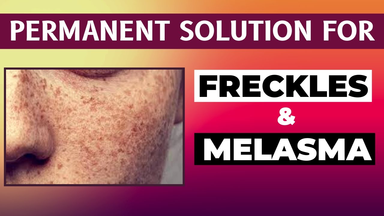Permanent Solution for Freckles & Melasma