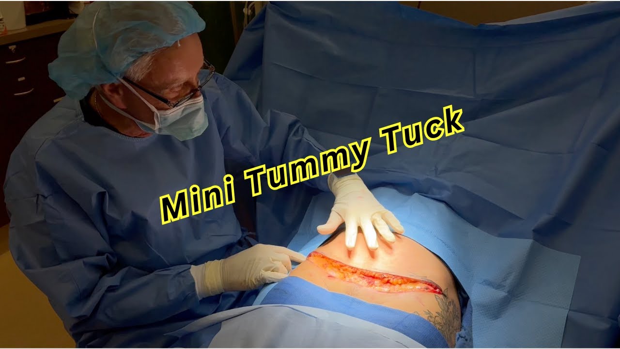 Mini Tummy Tuck | Orange County Plastic Surgery