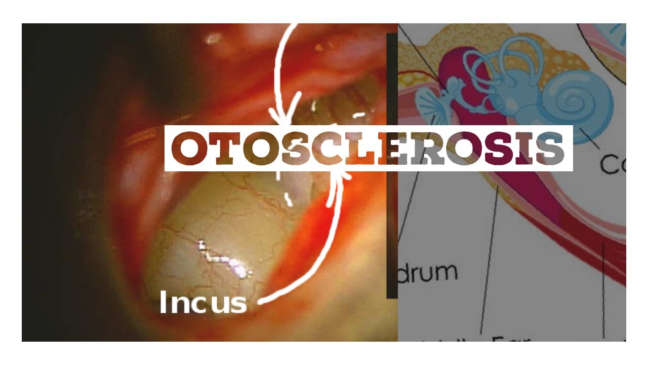 OTOSCLEROSIS | The White Army