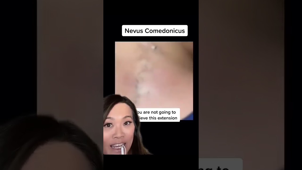 How do you avoid getting these blackheads and whiteheads? 👀