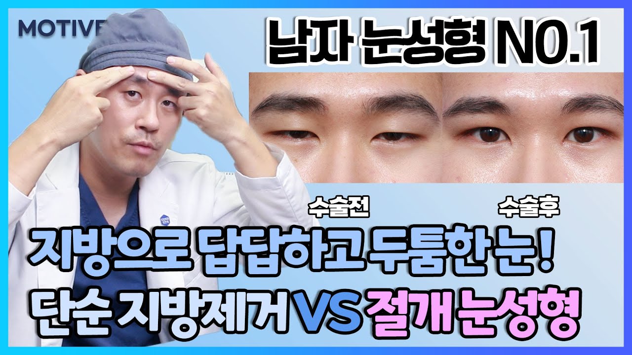 지방으로 답답하고 두툼한 눈. 단순 지방제거vs.절개 눈성형 #남자눈매교정