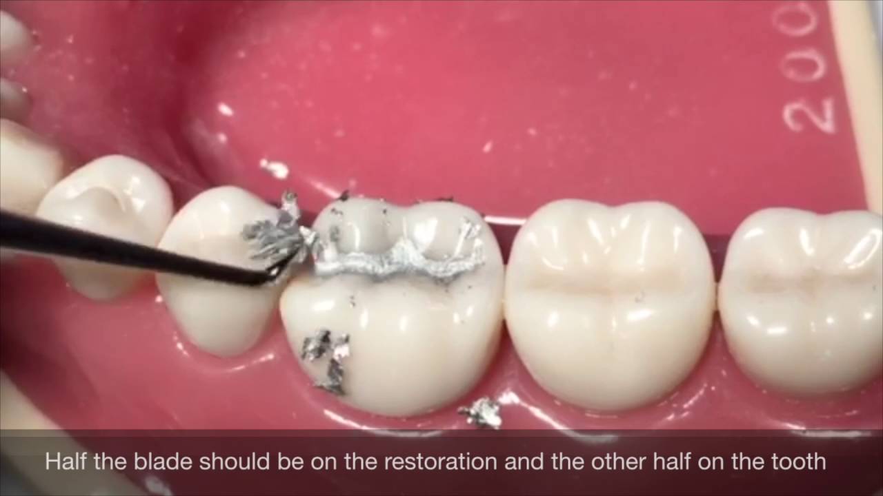 Class I Amalgam Cavity Preparation & Restoration