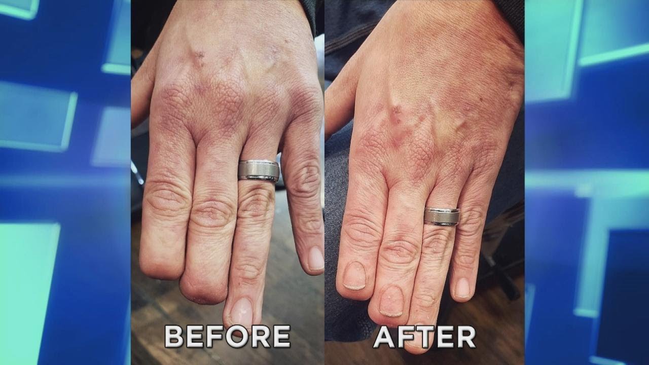 Man Gets Fingernail Tattoos after Losing Fingers!?