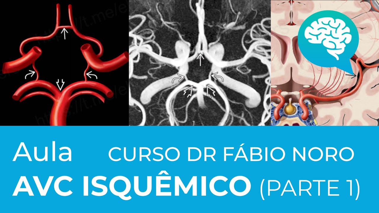 AVC ISQUÊMICO - CURSO DR FÁBIO NORO (PARTE 1)