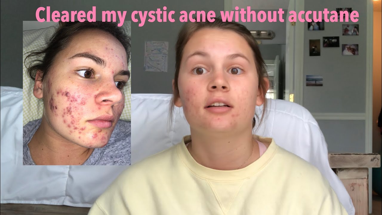 How I cleared my cystic acne without accutane