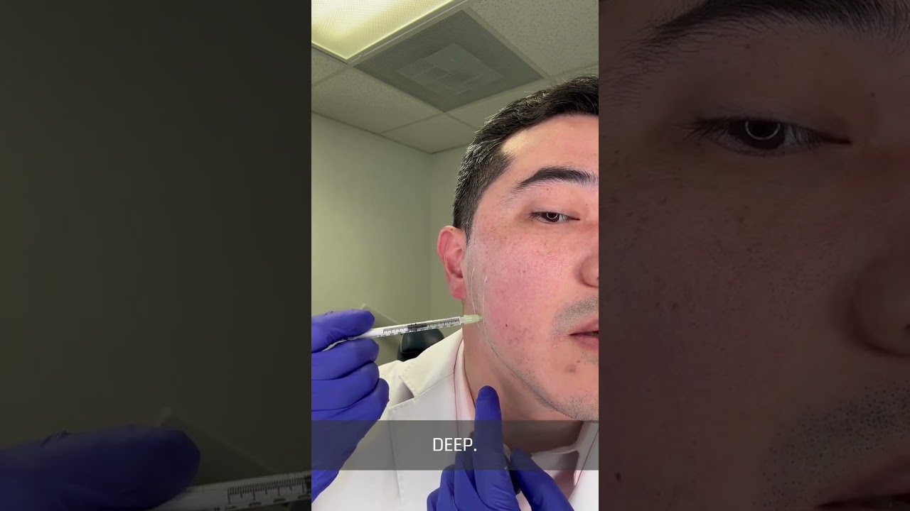 Part 2: Lower Dysport for Masseter Tox