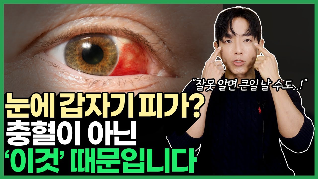 [sub] 눈에 갑자기 피가? 충혈? 출혈? 눈에 빨갛게 되는 원인과 치료에 대해 안과 전문의가 전부 알려드립니다. 결막하출혈, 충혈