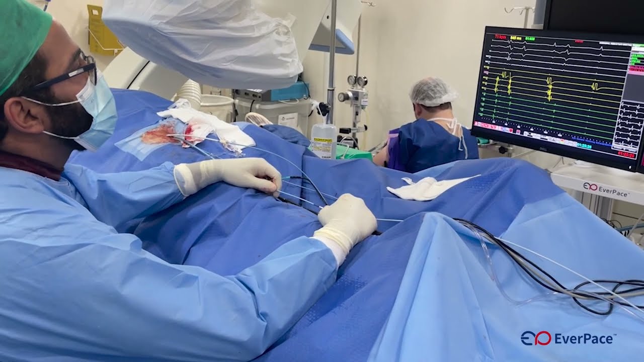 Fibrilação Atrial