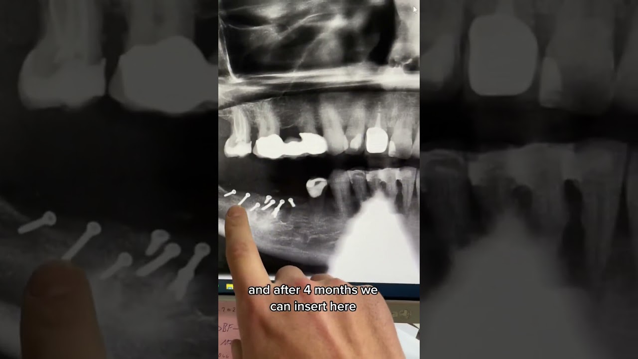 ##livesurgery #verticalgrafting #implantology #dentistry #demtalimplants #dişhekimi #implantfailure