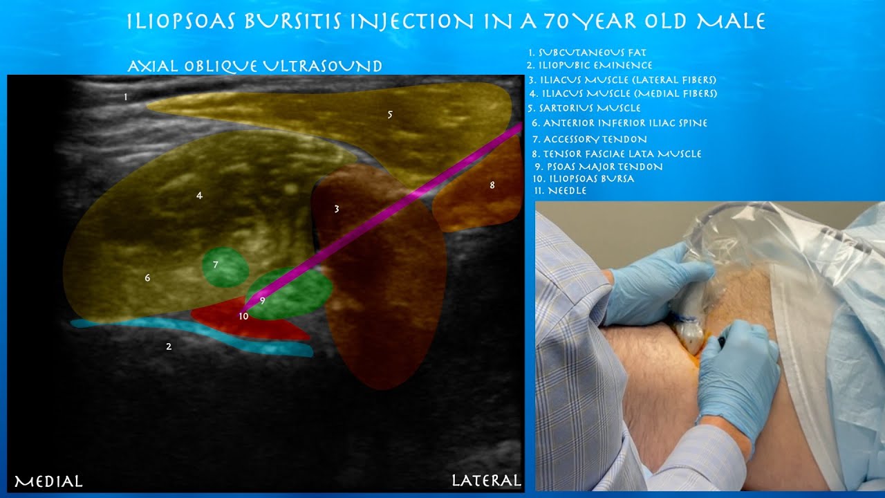 Ultrasound Guided Iliopsoas Bursts Injection by probeultrasound