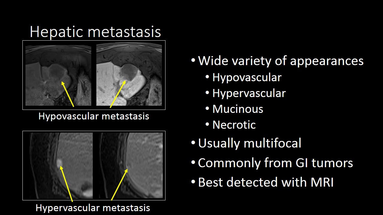 GI Imaging - Hepatic Metastasis