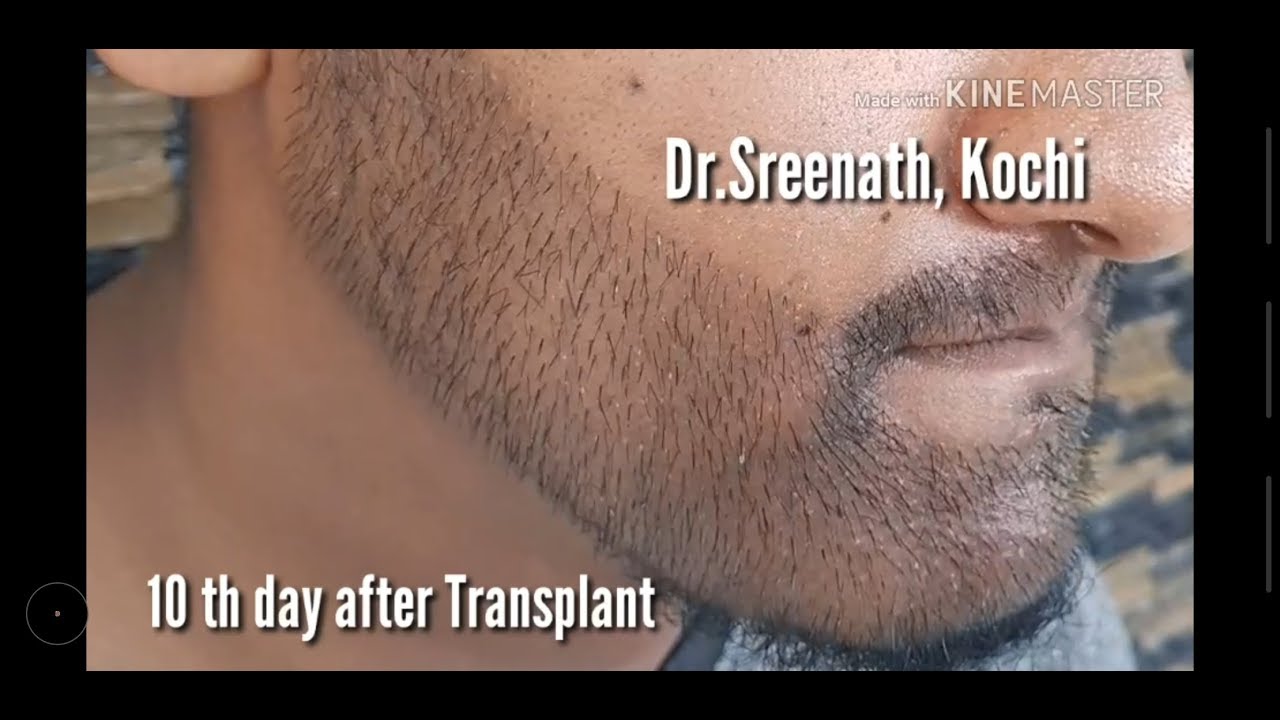 Beard Transplant results after 10 days | Tamil Movie Celebrity | Dr.Sreenath | Beard Transplant