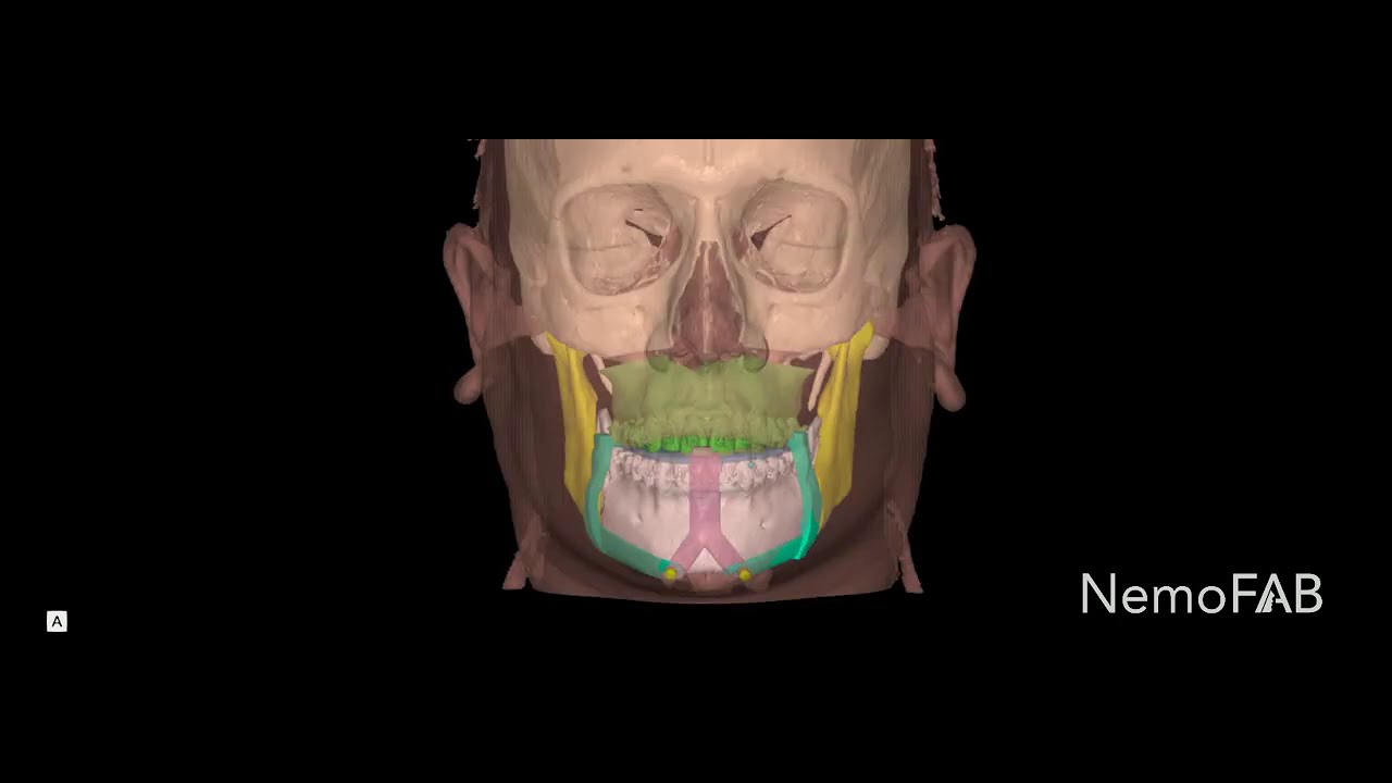 Maxilofacial Surgery Planning