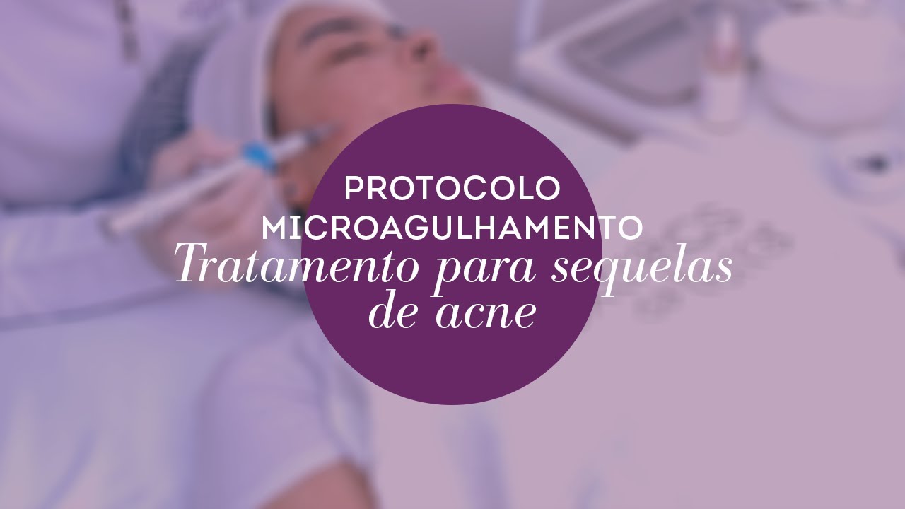 Protocolo Facial Antiacne Microagulhamento:  Tratamento para Sequelas de Acne