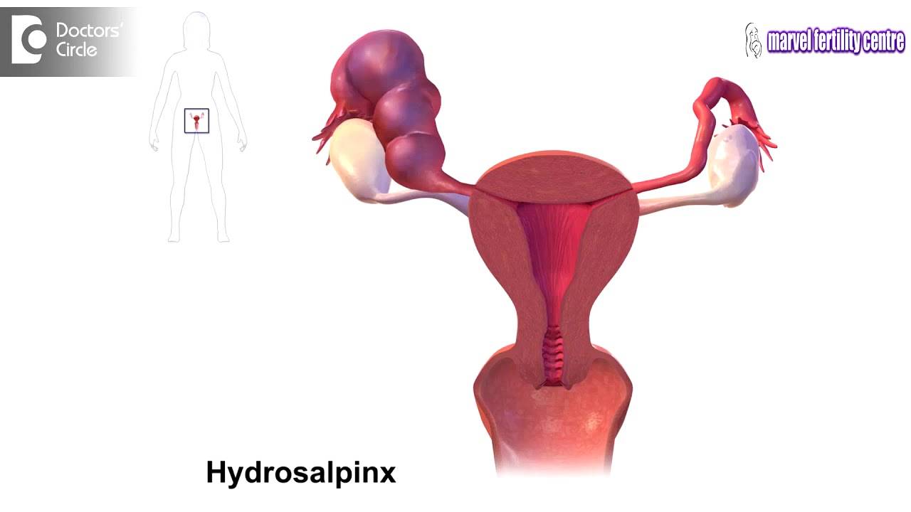 Can antibiotics help in treating Hydrosalpinx Dr Mamatha Reddy YV