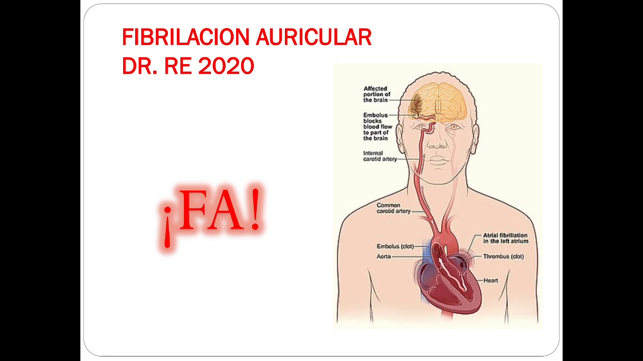 FIBRILACION AURICULAR / ENARM