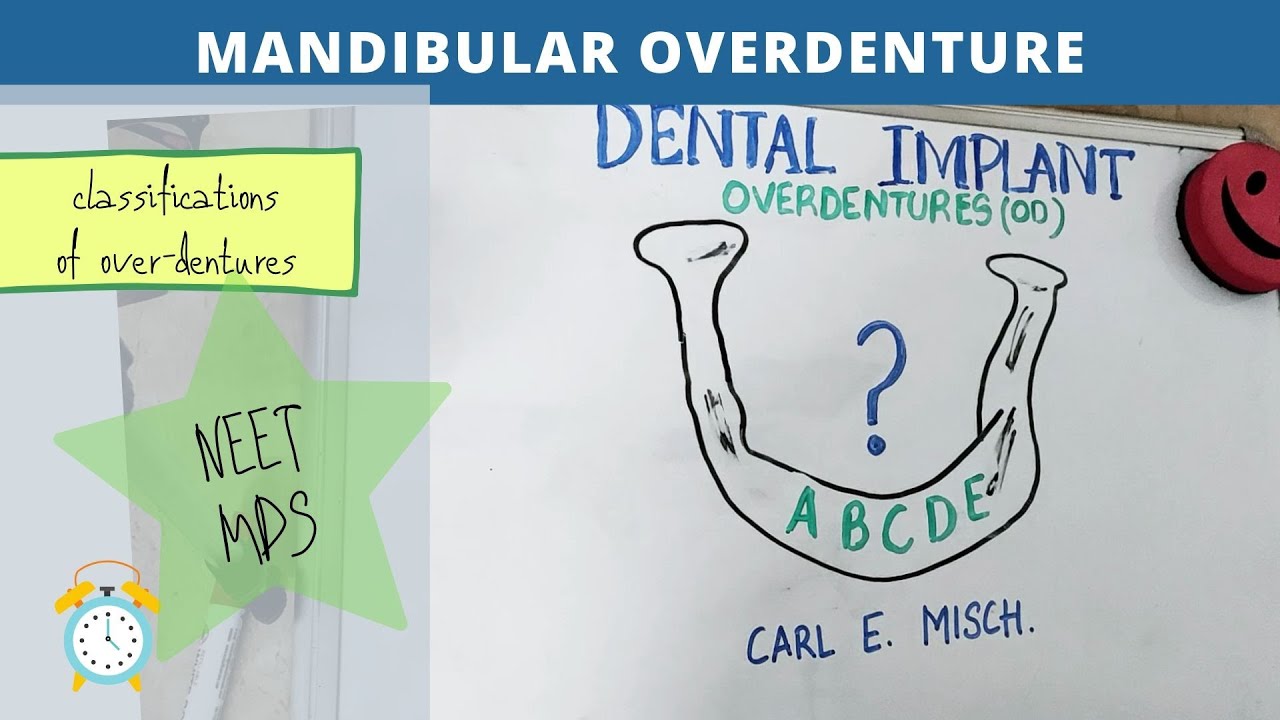 easy explanation of overdenture implant (mandibular overdenture)