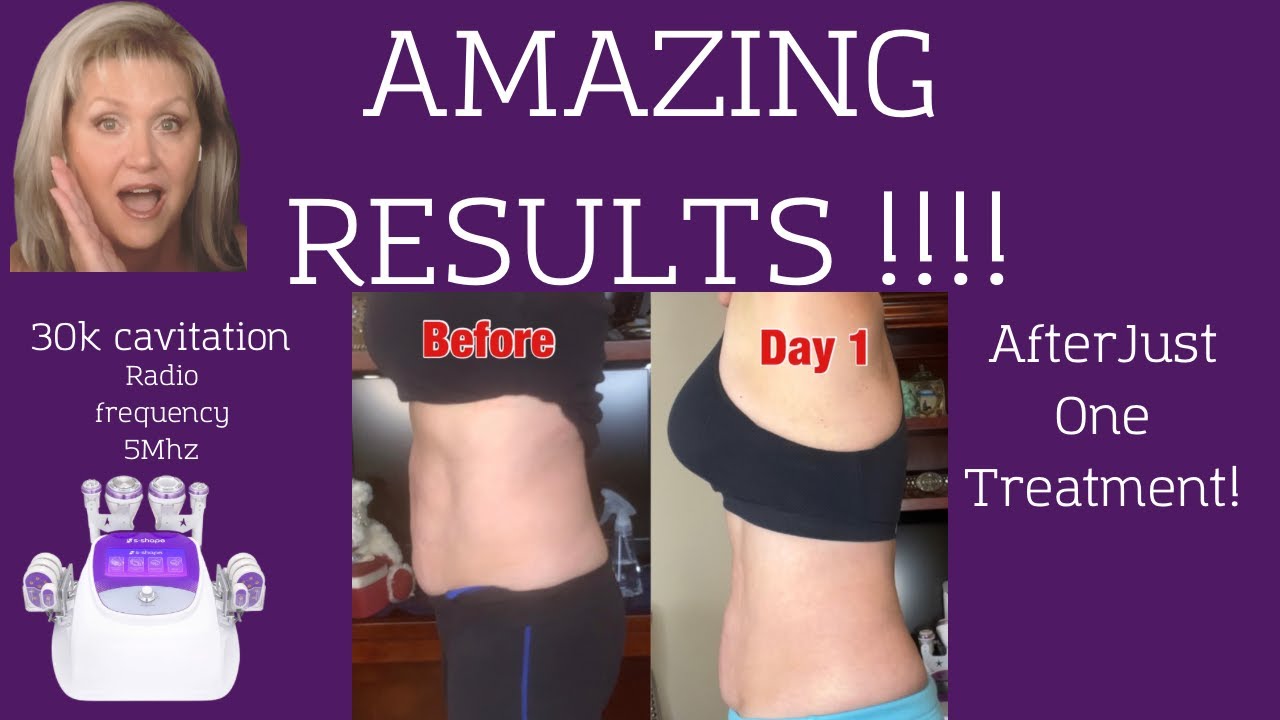 S-Shape Pro  |  ZAP YOUR FAT with at home CAVITATION & RADIO FREQUENCY SKIN TIGHTENING