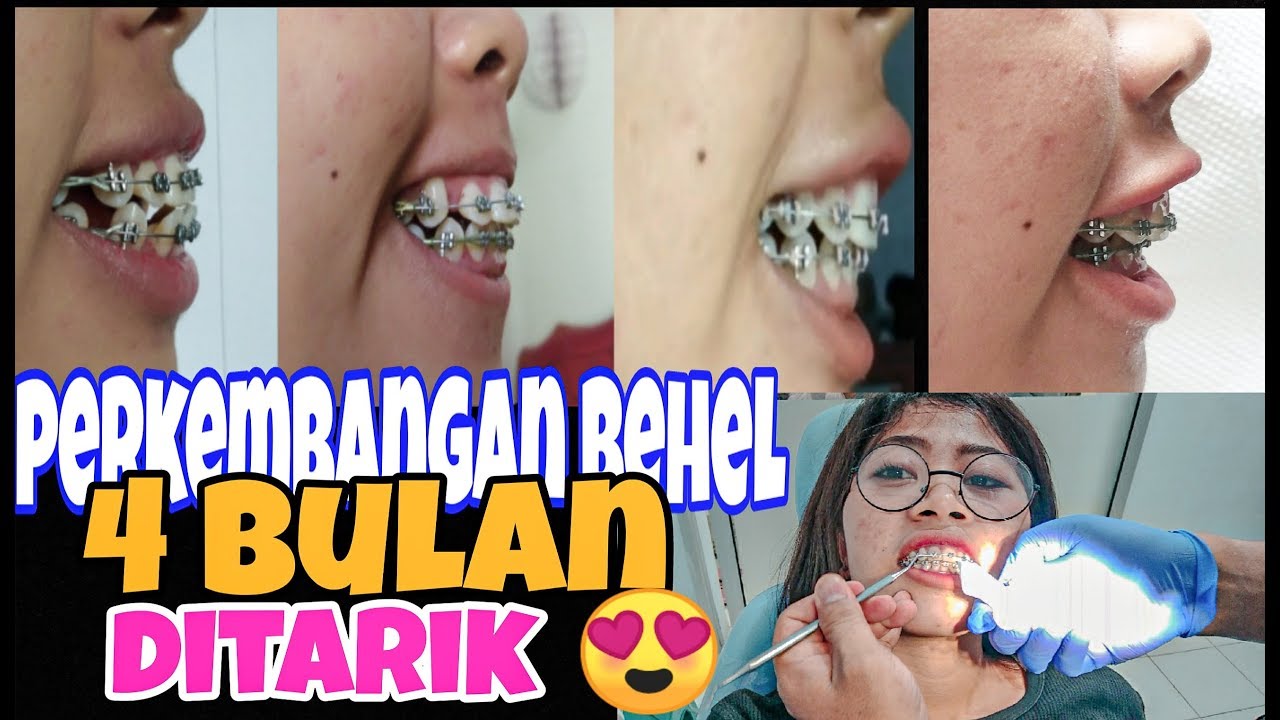 HASIL GIGI DITARIK SELAMA 4 BULAN,😍 GIGI RAPI CEPET BANGET ❤