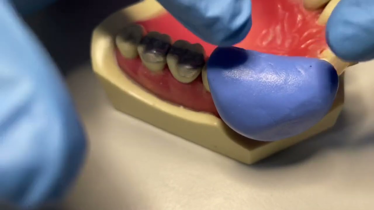 ADC technical task, making good putty key for PFM crown prep