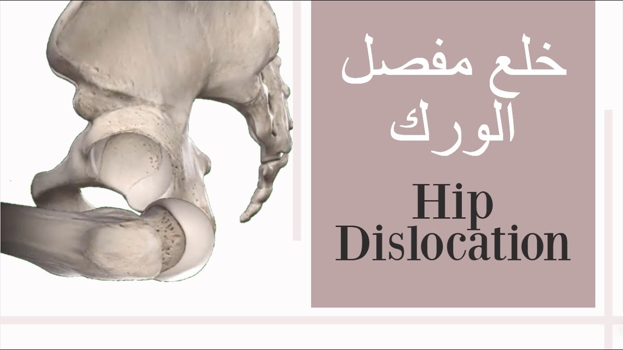 خلع مفصل الورك - Hip joint dislocation (subtitled)
