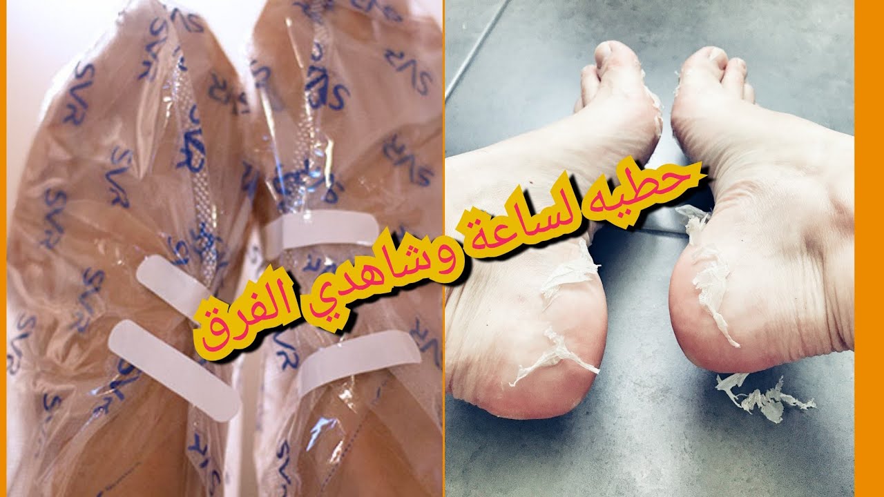 في ساعة واحدة احصلي على رجلين ناعمتين بمنتج واحد(svr xerial peel).