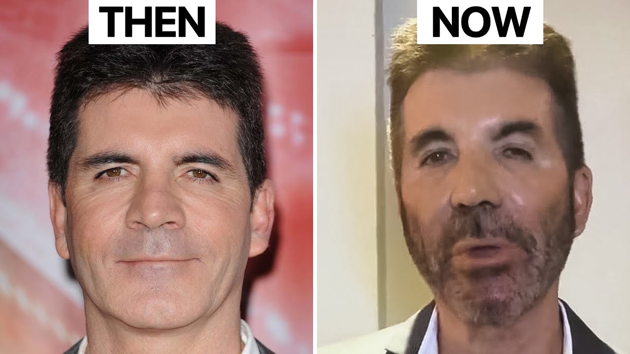 Simon Cowell NEW LOOK | Plastic Surgery Analysis