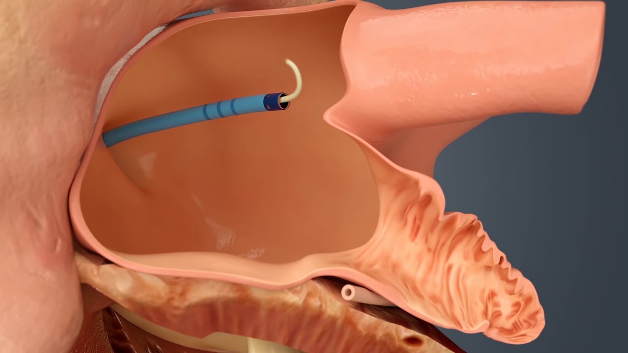 Treating AFib With The WATCHMAN Implant, A Drug-Free Alternative
