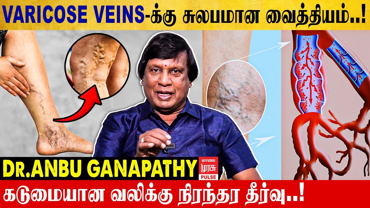 How to Get Relief from Varicose Veins? | Dr. Anbu Ganapathy Shares Solutions
