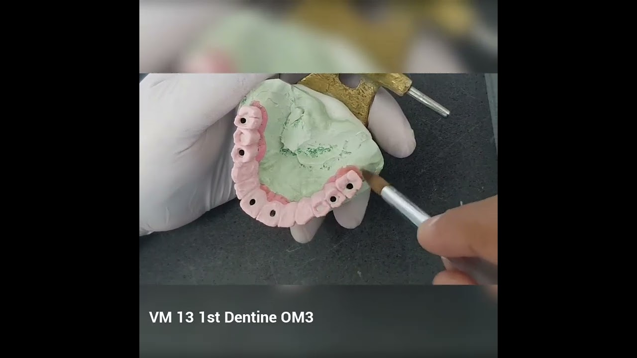 Vita VM13 PFM Bridge Over Implant