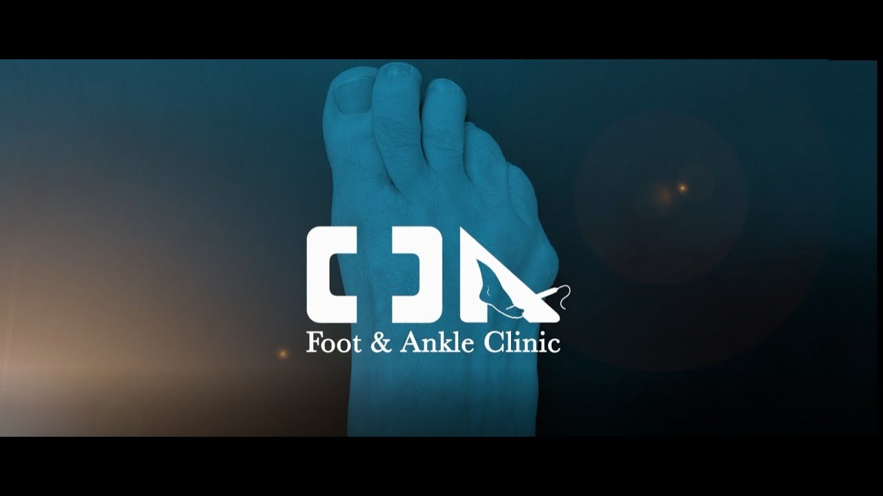 Minimally Invasive Severe Tailor's Bunion Surgery