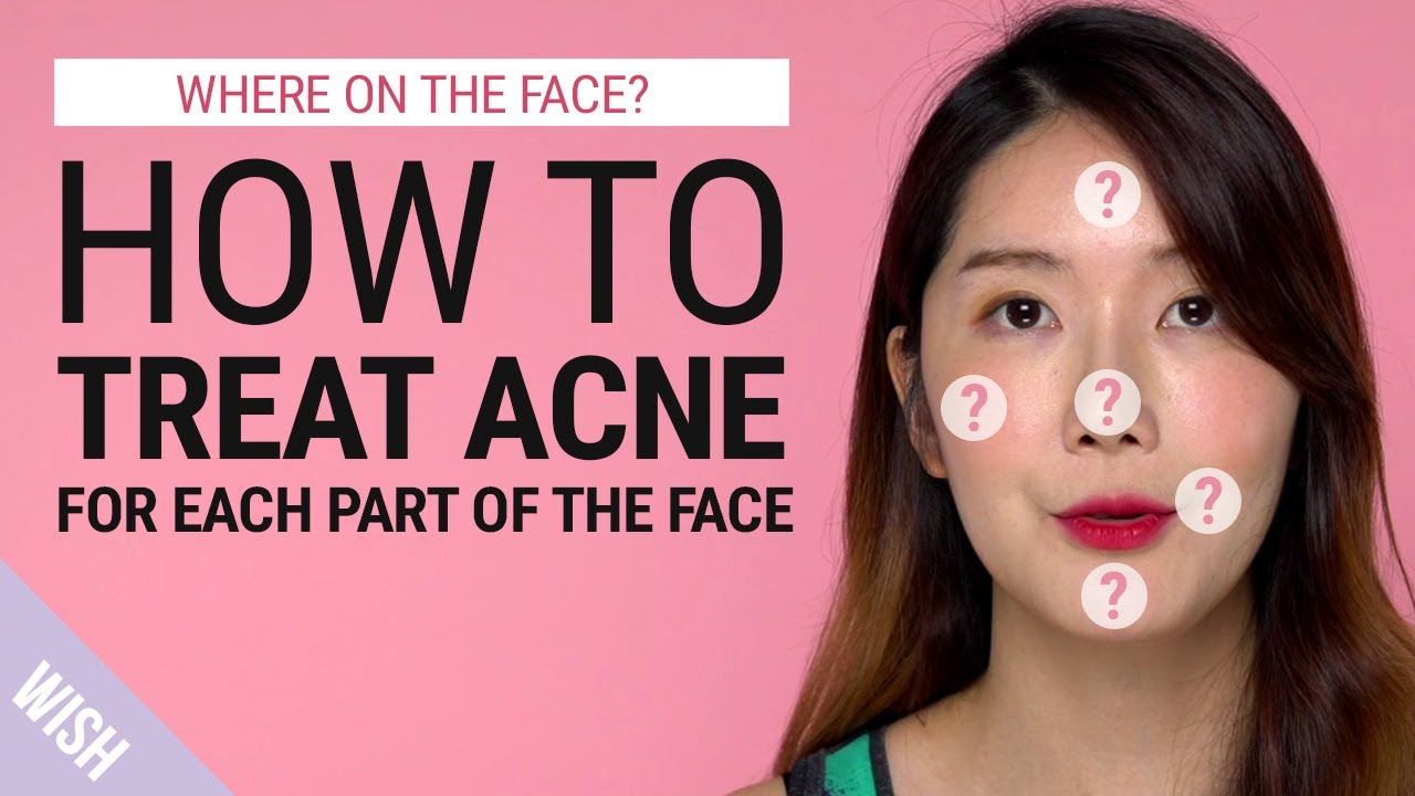 Acne 101 | Different Acne Meaning According to Different Parts of the Face | Wish Beauty 101