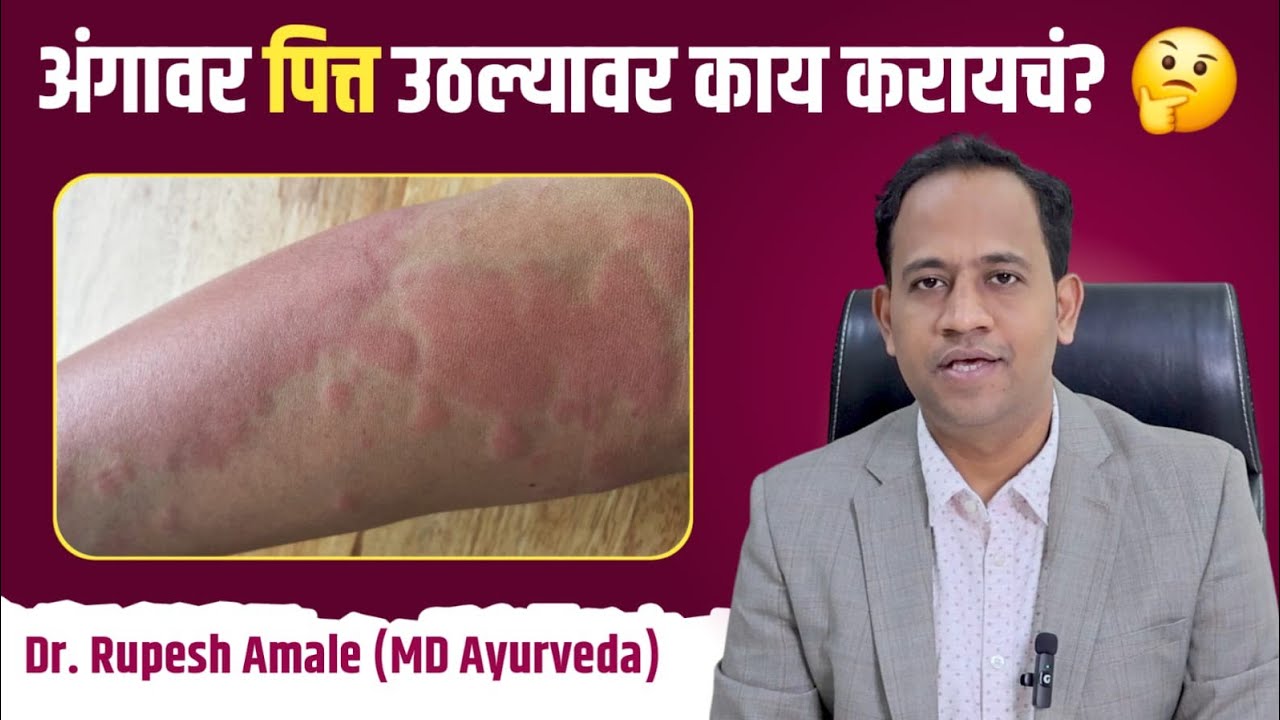 अंगावर पित्त का उठते? शीतपित्त अचूक निदान आणि उपाय l Urticaria by Dr. Amale