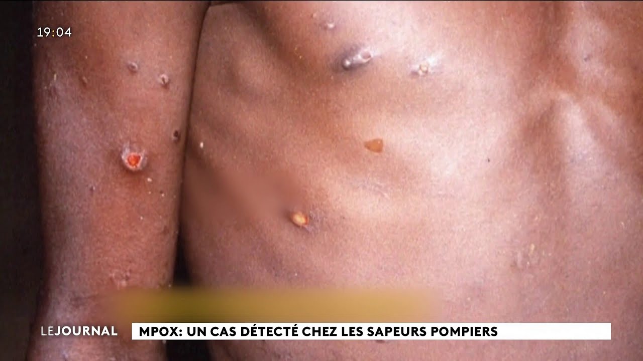MPOX : un cas détecté chez les sapeurs-pompiers