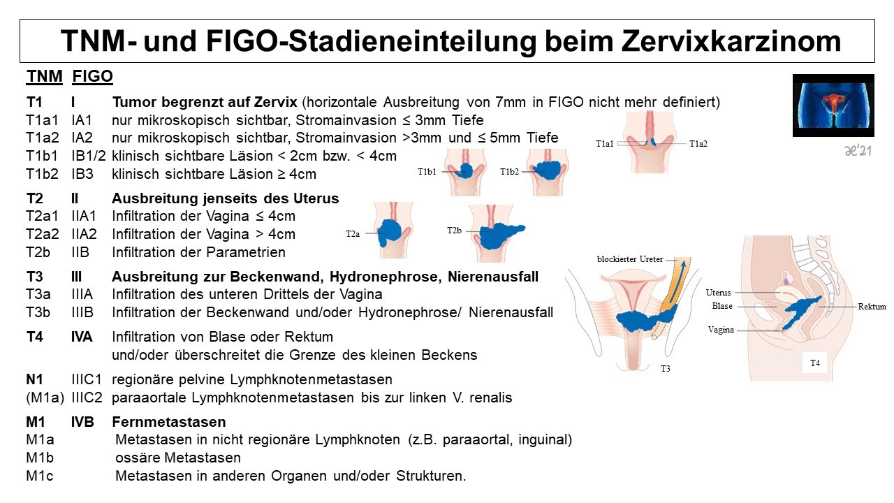 TNM- und FIGO-Stadieneinteilung beim Zervixkarzinom | Strahlentherapie Prof. Hilke Vorwerk