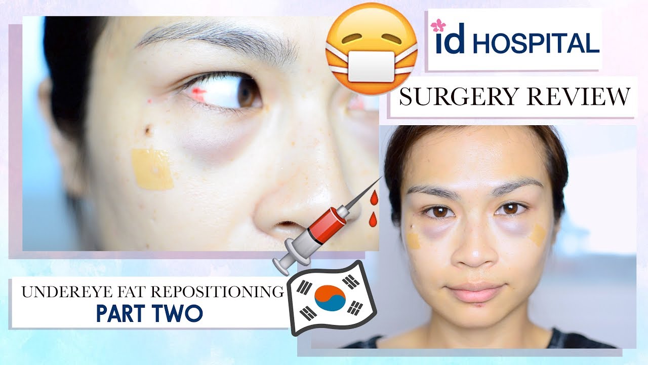 My Plastic Surgery Experience in Korea (Part 2)⎮Under Eye Fat Re-positioning/ Eye Bag Removal