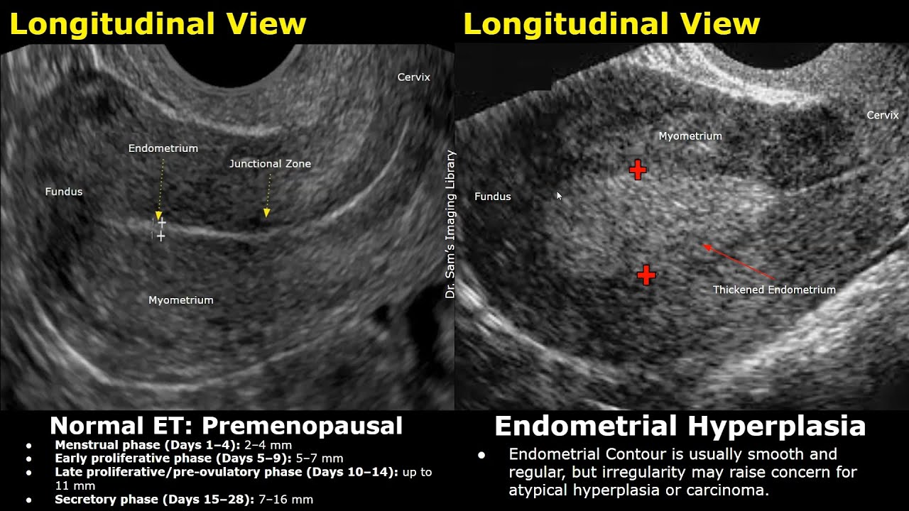Uterus Ultrasound Normal Vs Endometrial Hyperplasia Images | Premenopausal & Postmenopausal Cases