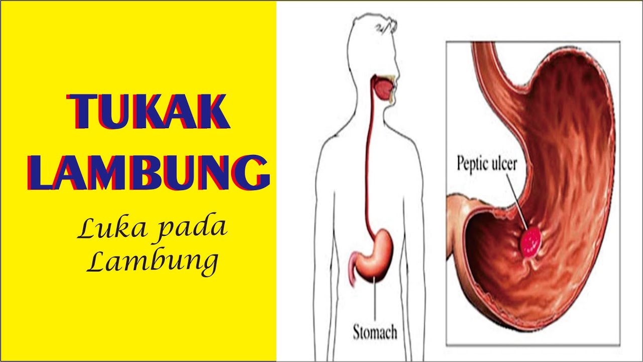 TUKAK LAMBUNG, Definisi, Gejala, Penyebab, Pengobatan dan Pencegahan