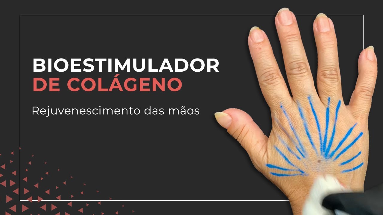 APLICAÇÃO DE BIOESTIMULADOR NAS MÃOS - Região das mãos - Bioestimulador de colágeno