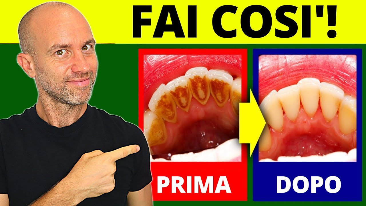 Rimedi NATURALI per PLACCHE e CARIE