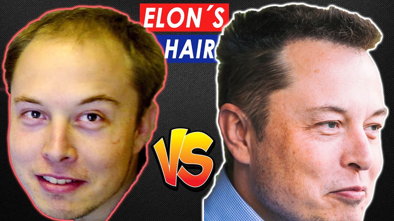 How Elon Musk Got His Hair BACK!