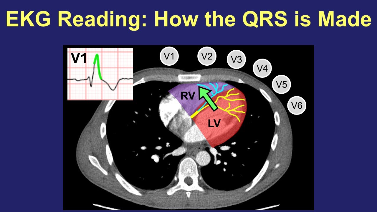 EKG Reading: How the QRS is Made
