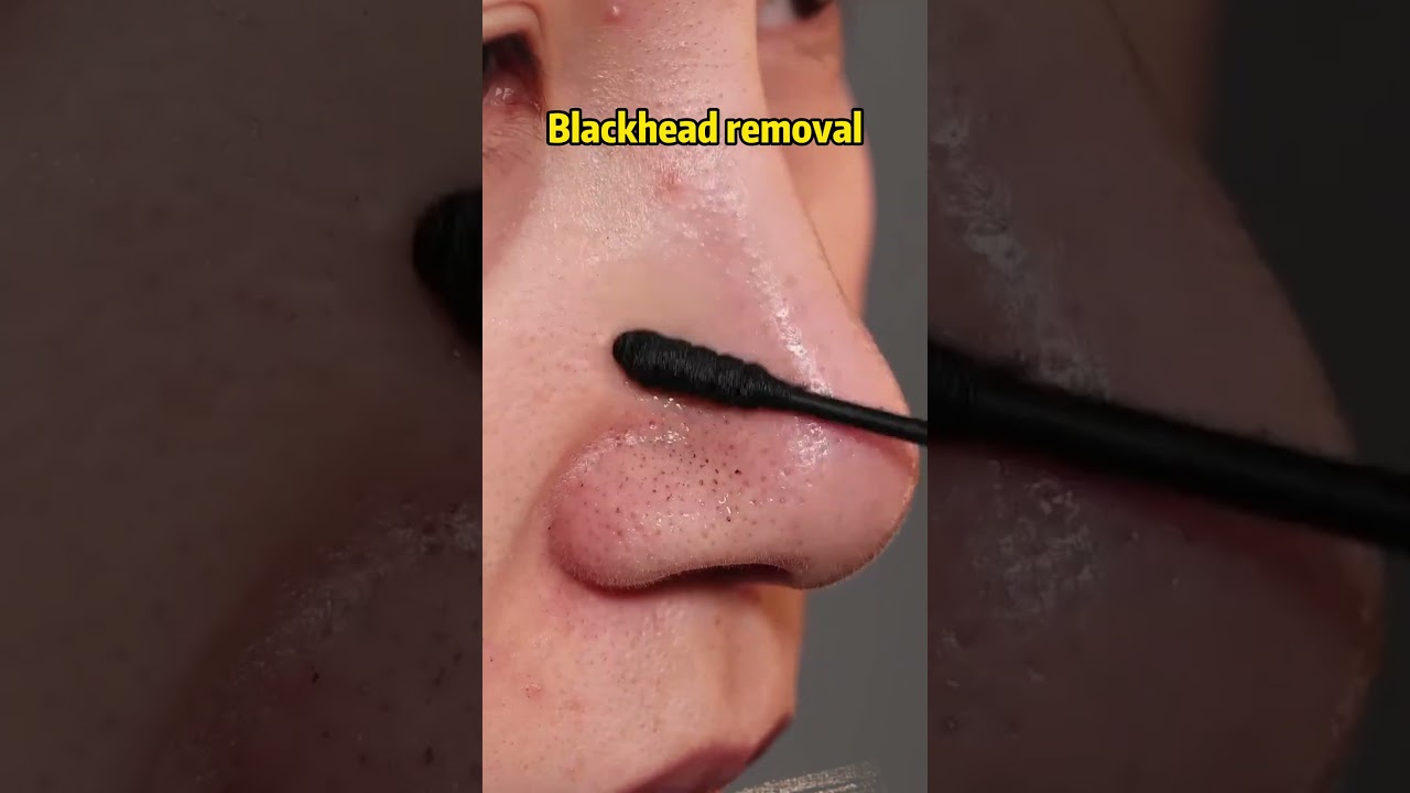 The best blackhead removal #blackheads #skincare #blackheadremoval mover